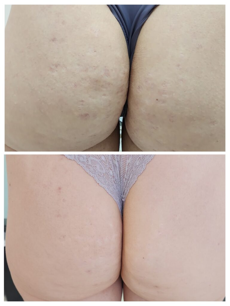 Antes e depois